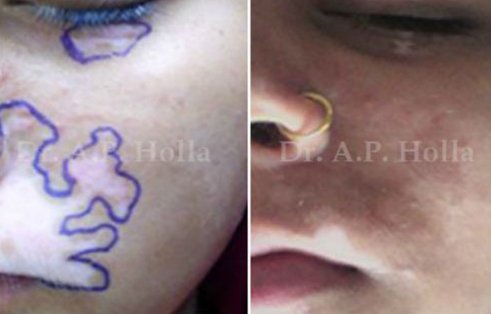  cheek vitiligo treatment   delhi