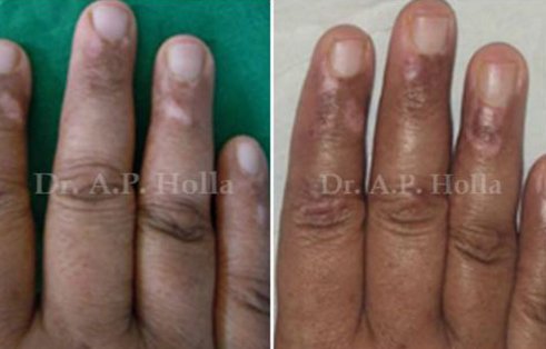 finger vitiligo treatment   delhi