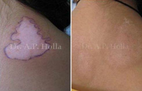 neck vitiligo treatment delhi