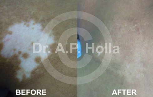 skin pigmentation treatment   delhi