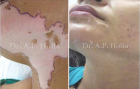 skin white patch treatment   delhi