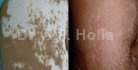 treatment for vitiligo delhi