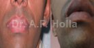 treatment for vitiligo in lips