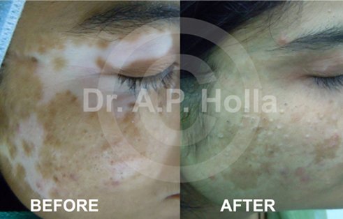vitiligo treatment fro face in   newdelhi